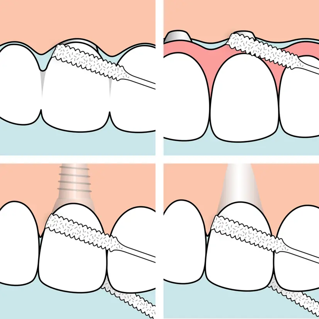 TePe Köprü ve İmplant Diş İpi (Bridge & Implant Floss)